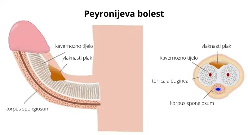 peyronijeva bolest slika